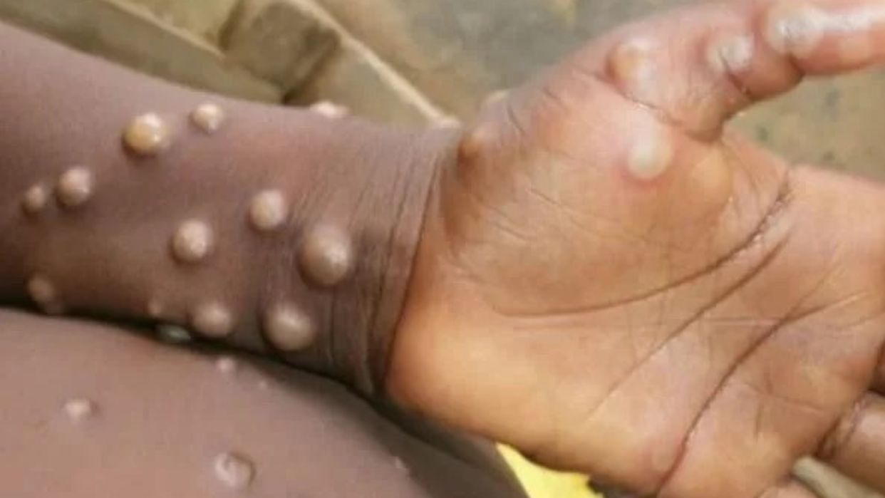 OMS en alerta ante la nueva cepa más letal del virus Mpox que avanza en África